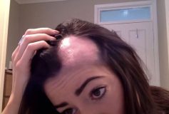 Quels traitements la perte de cheveux chez la femme ?